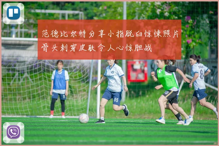 范德比尔特分享小指脱臼惊悚照片骨头刺穿皮肤令人心惊胆战